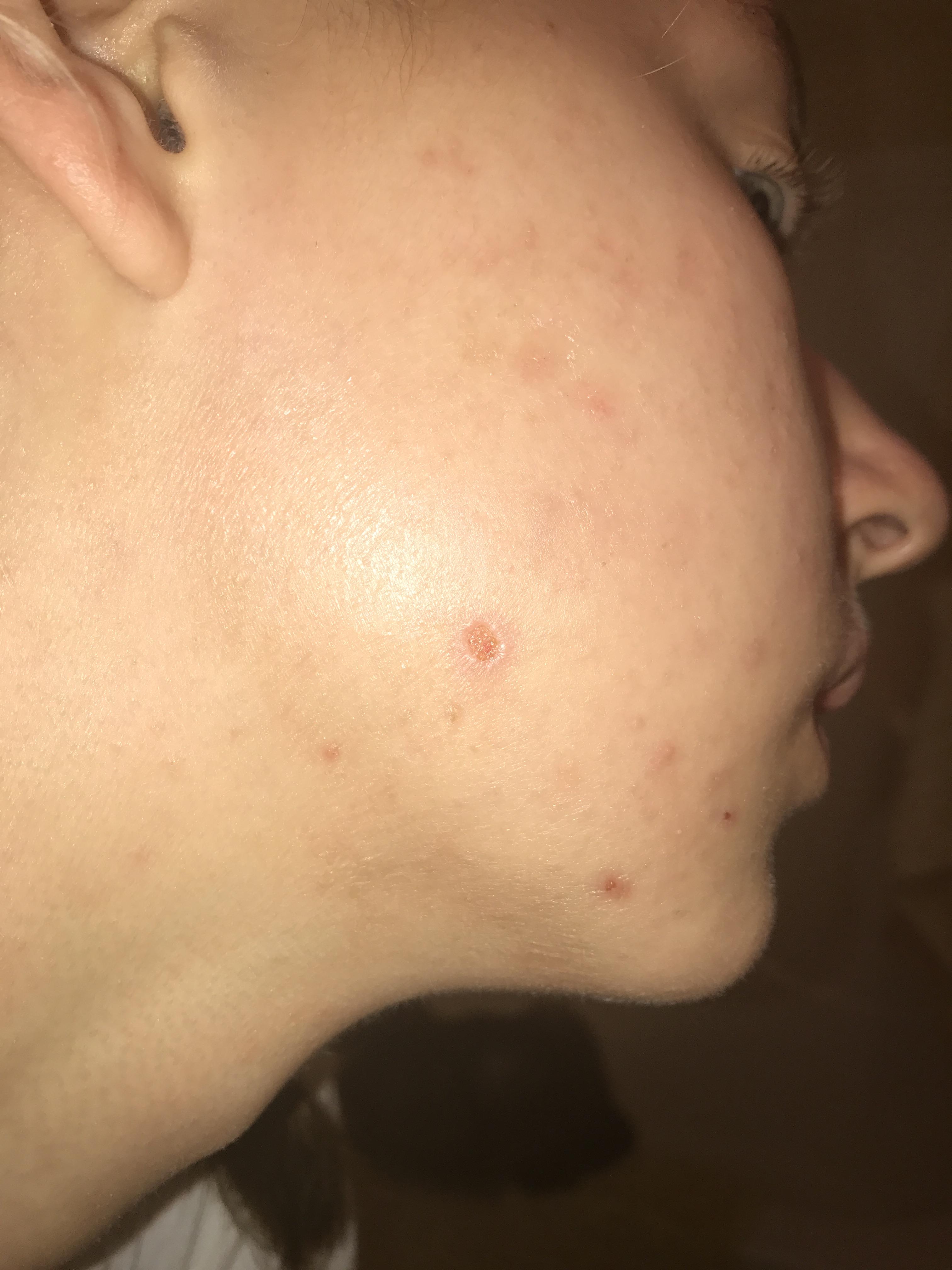 Embankment detektor kalv HELP!! picked scab too soon, hole on cheek! – General acne discussion –  Acne.org Forum