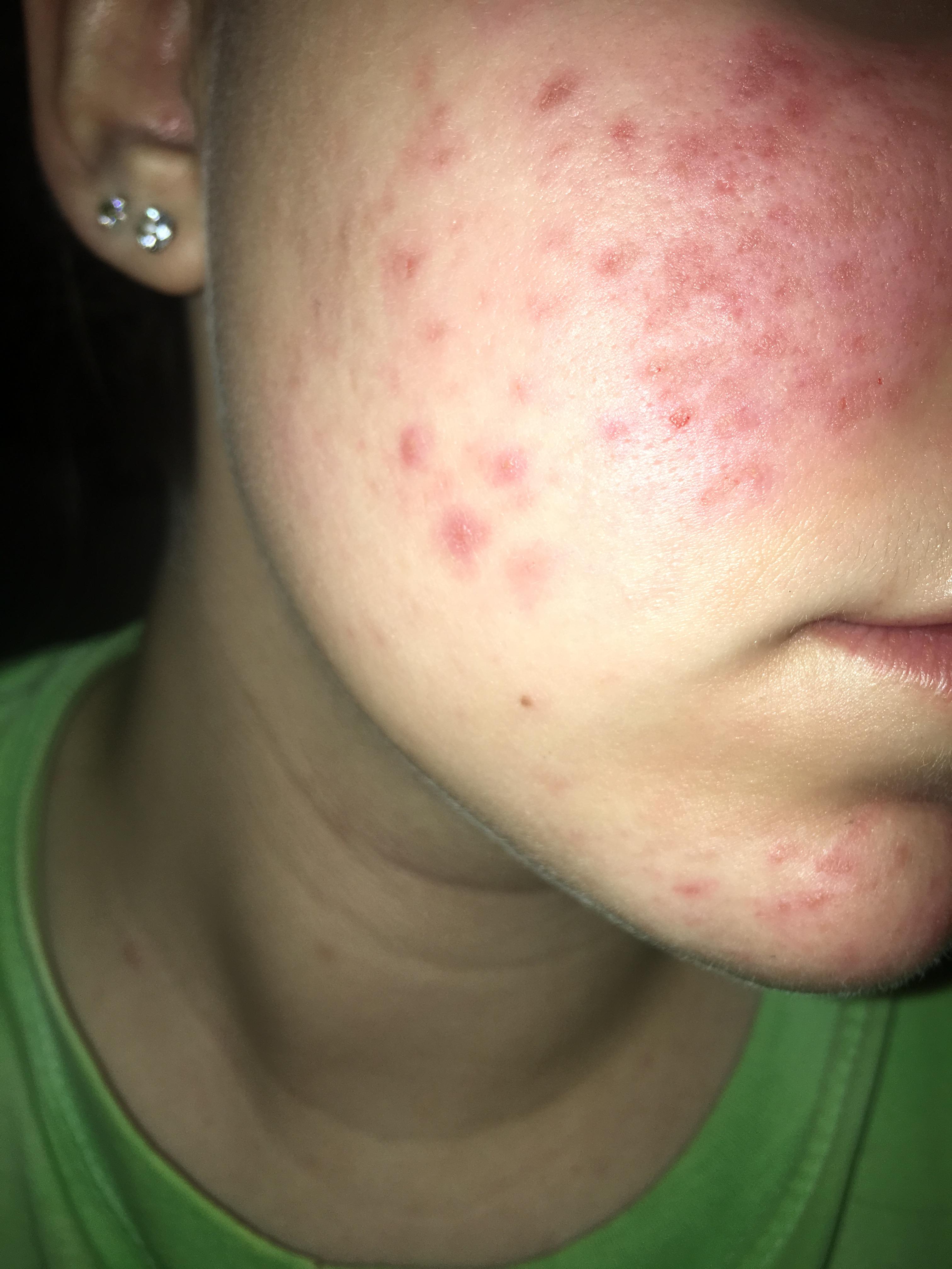 irritated-enlarged-pores-general-acne-discussion-by-0kjec-acne