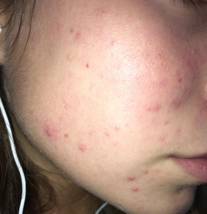 Acne Bumps Face Cysts Period Around Nasty Getting.