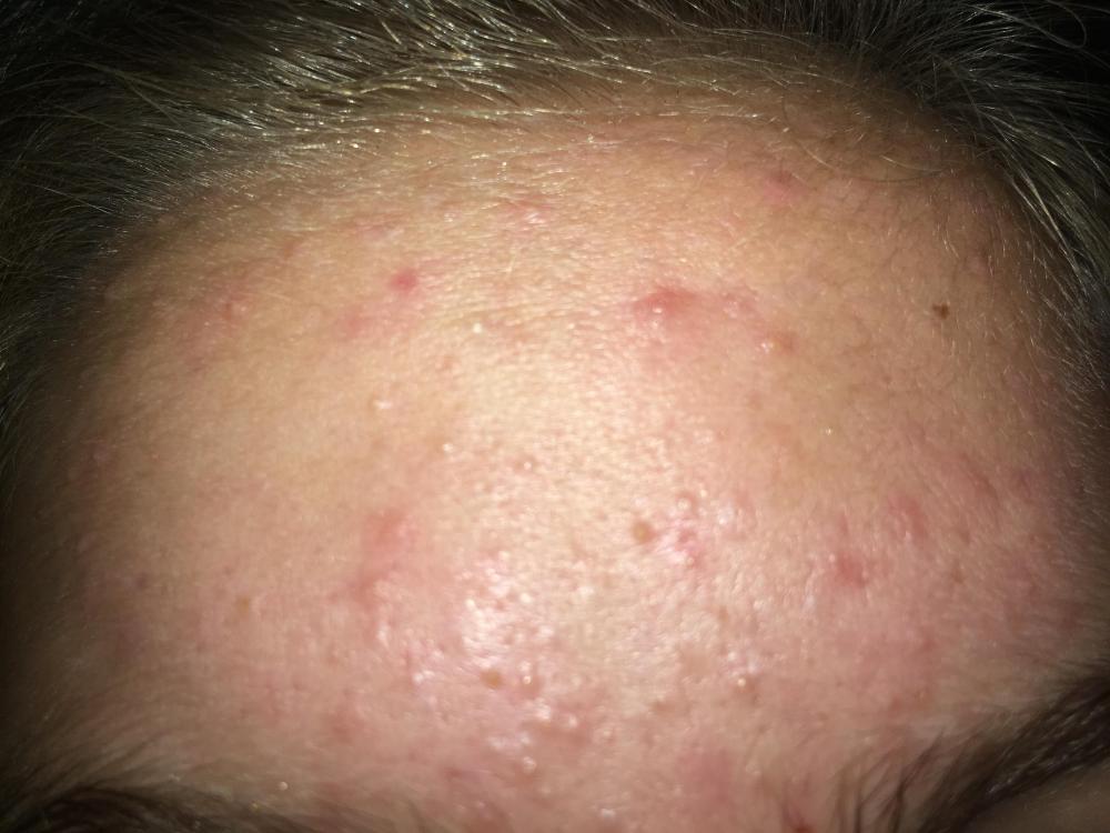 Small bumps all over face and cysts - General acne discussion - by