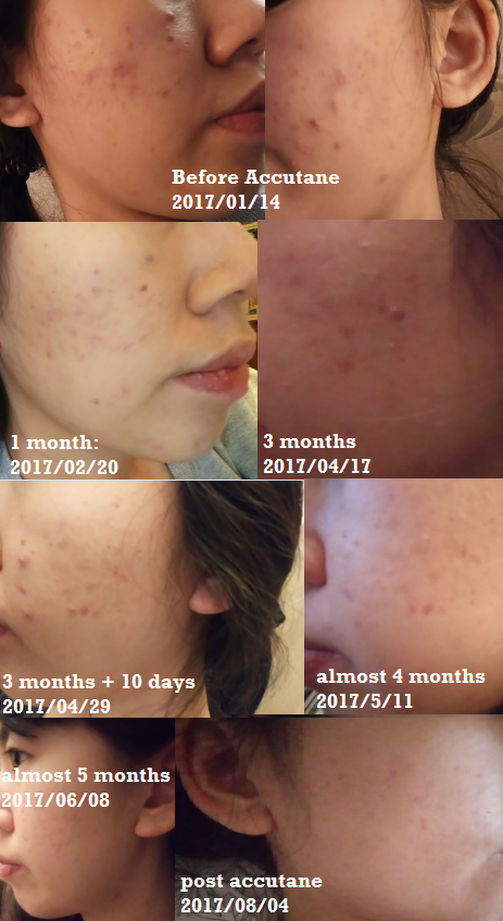 acne scars before and after accutane