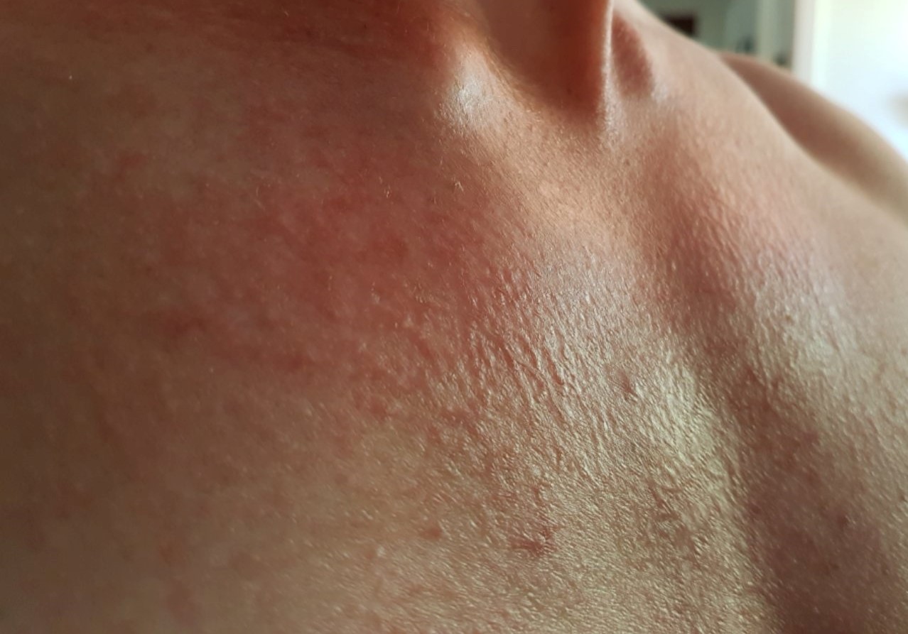 Extremely red and dry skin on chest The Regimen Forum