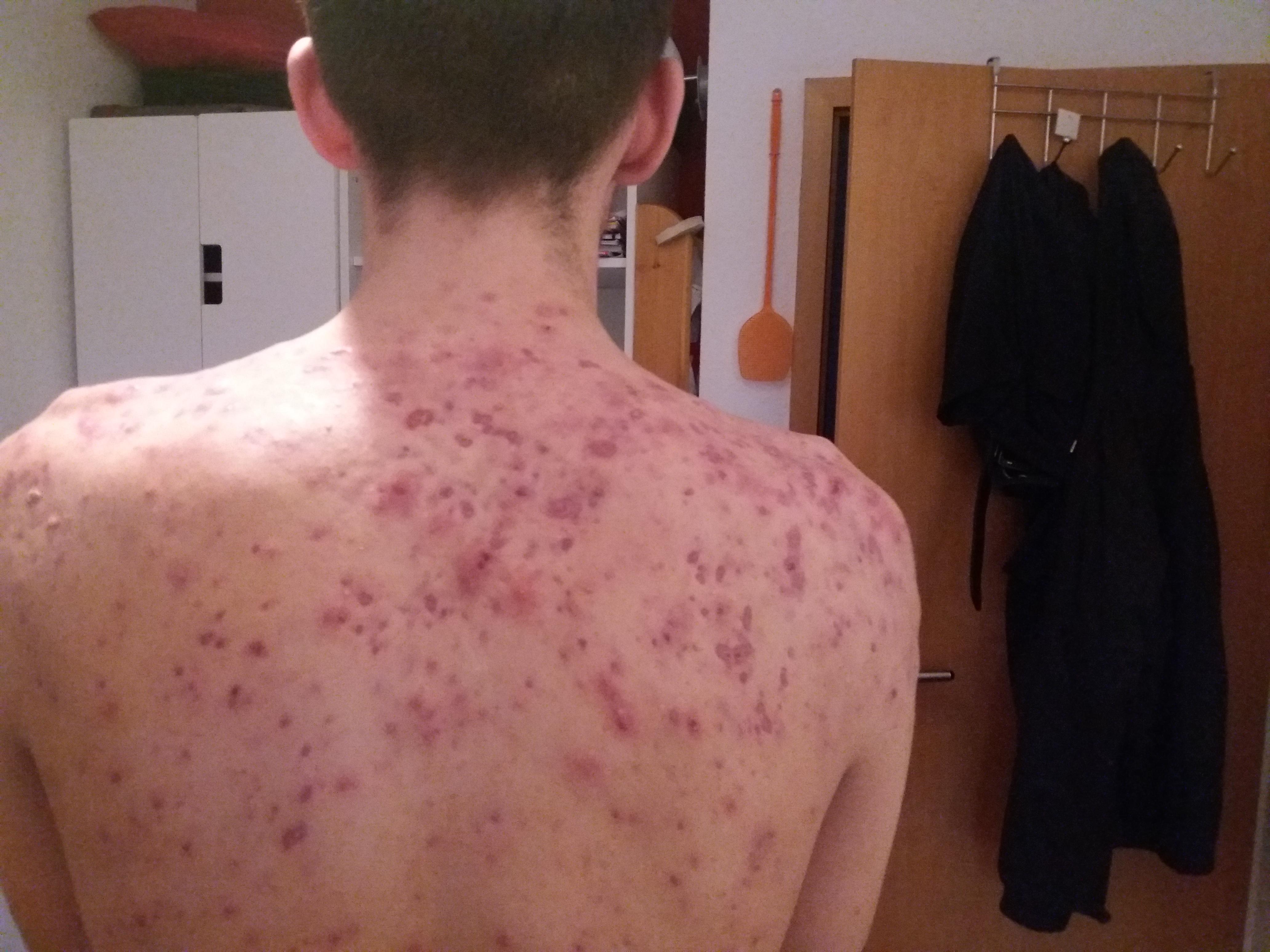 Accutane before and after w/ pictures - Prescription acne ...