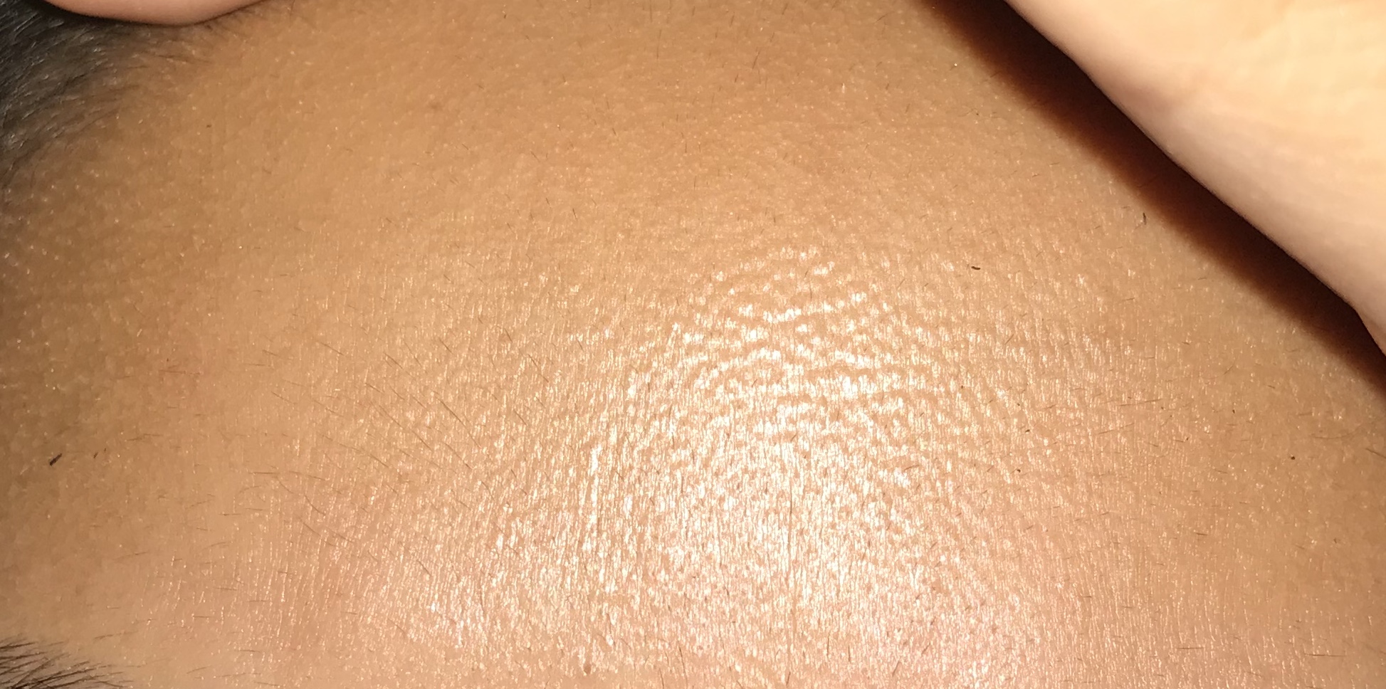 Tiny Flesh Colored Bumps On Forehead General Acne Discussion Acne