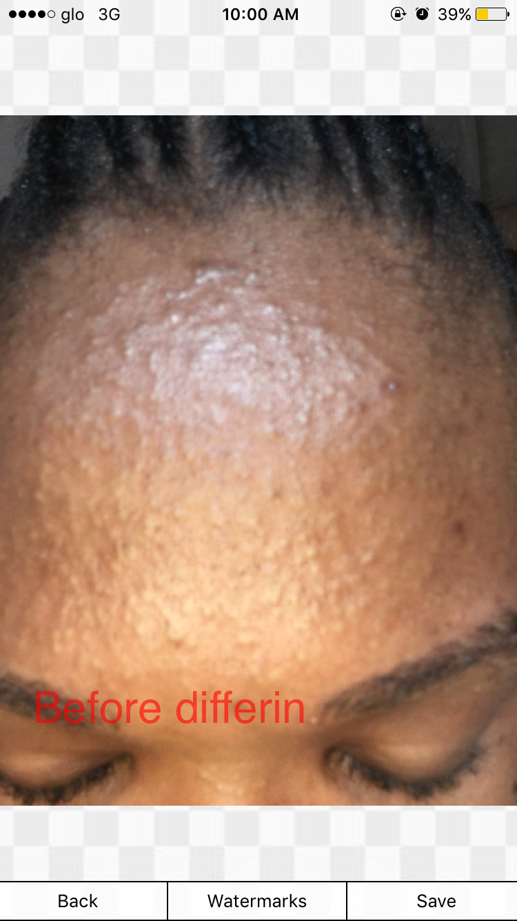 differin does acne alone works prescription