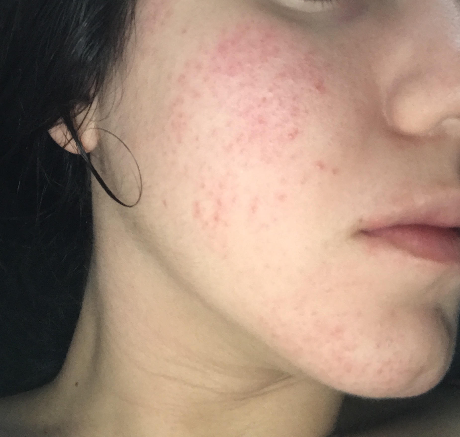 Helppp Could This Be Acne Rosacea Pictures Included Rosacea