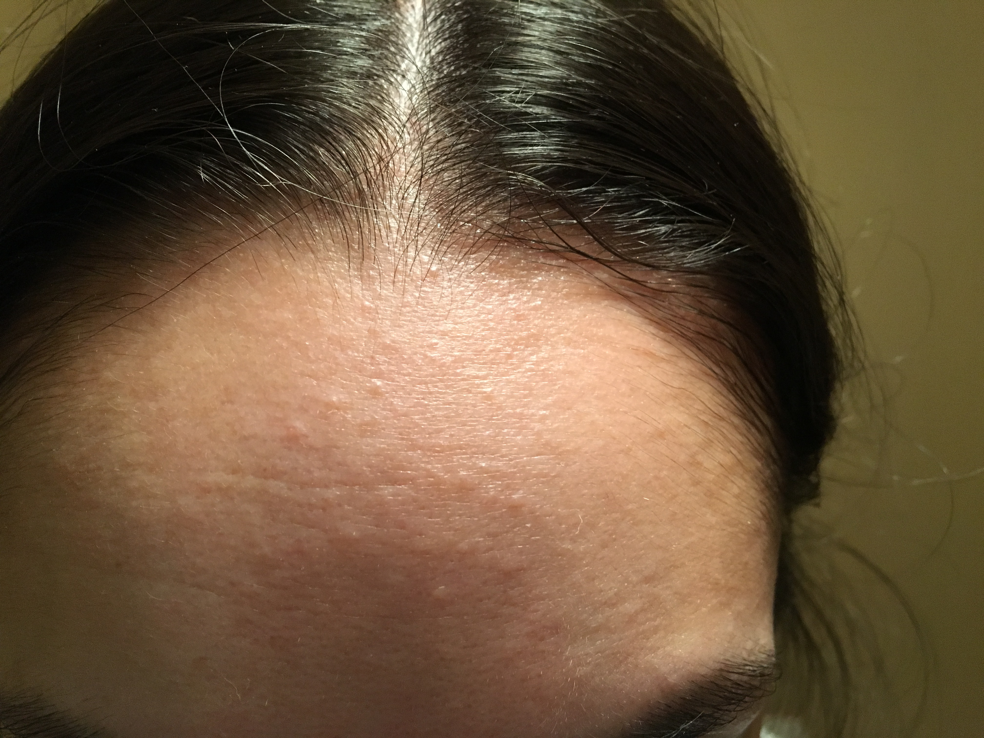 Small Forehead Bumps That Won T Go Away General Acne Discussion Acne Org