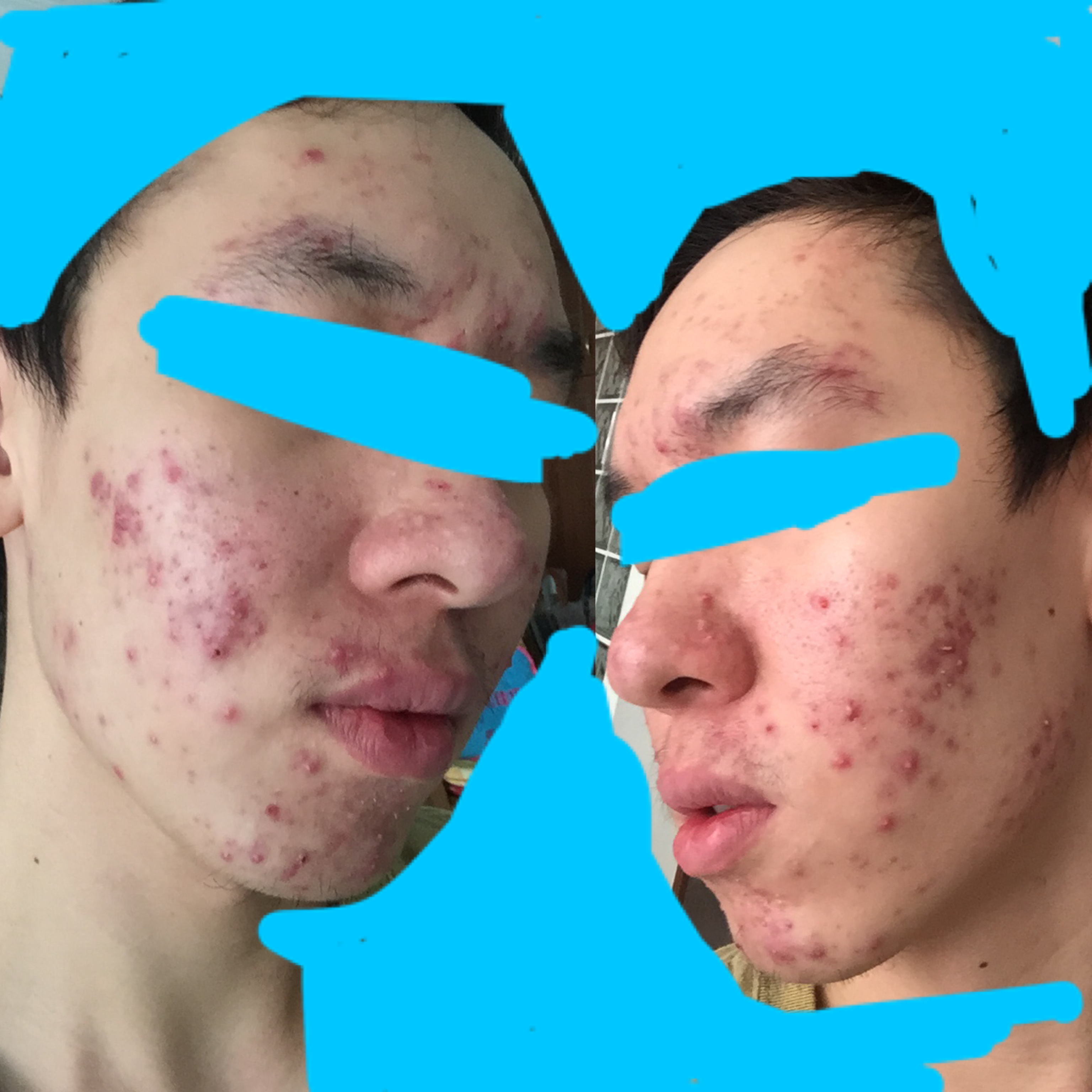 Prezzo accutane