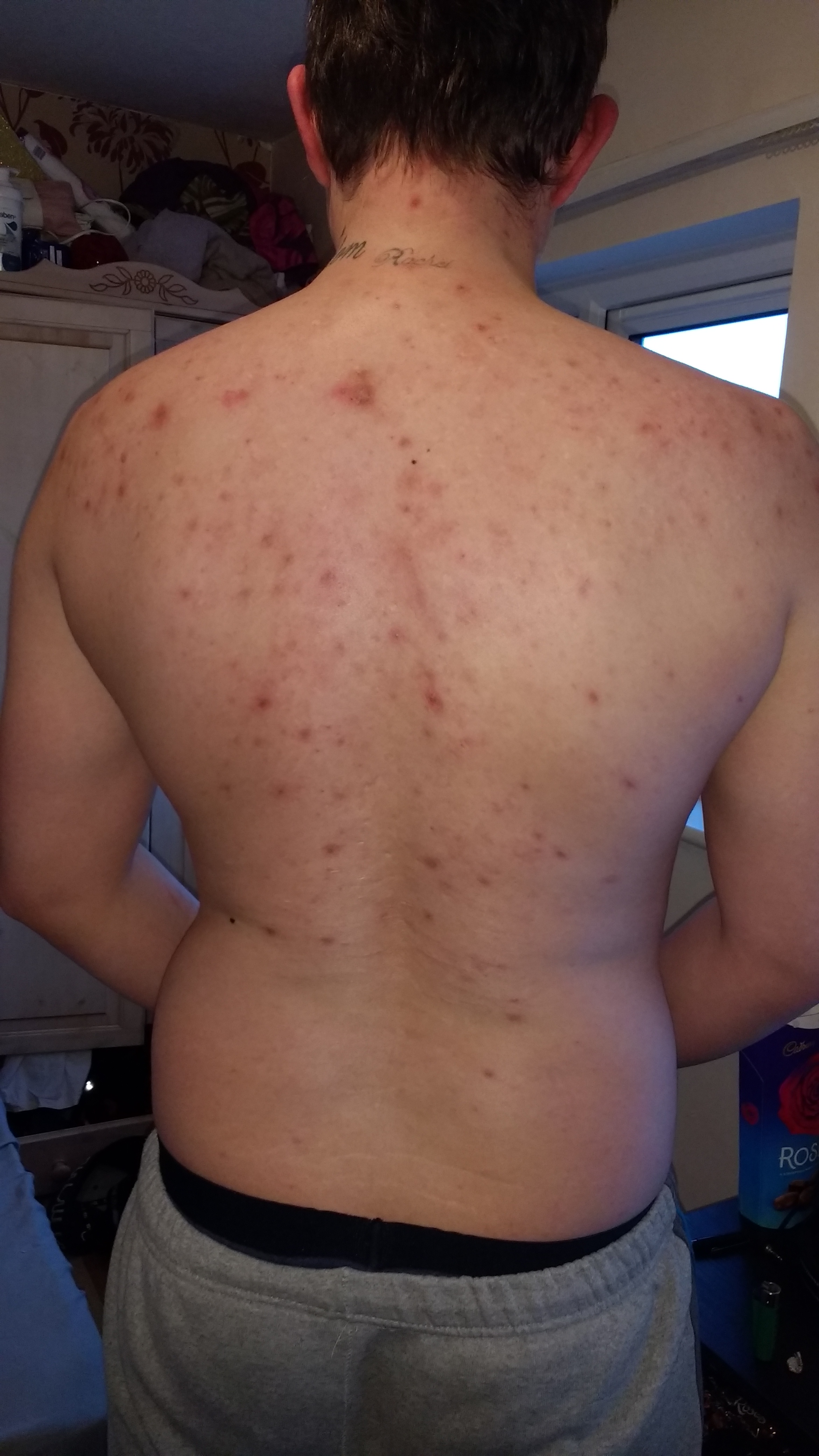 Back Acne Clearing Up 9 Months Later. Before and After. - Back/Body