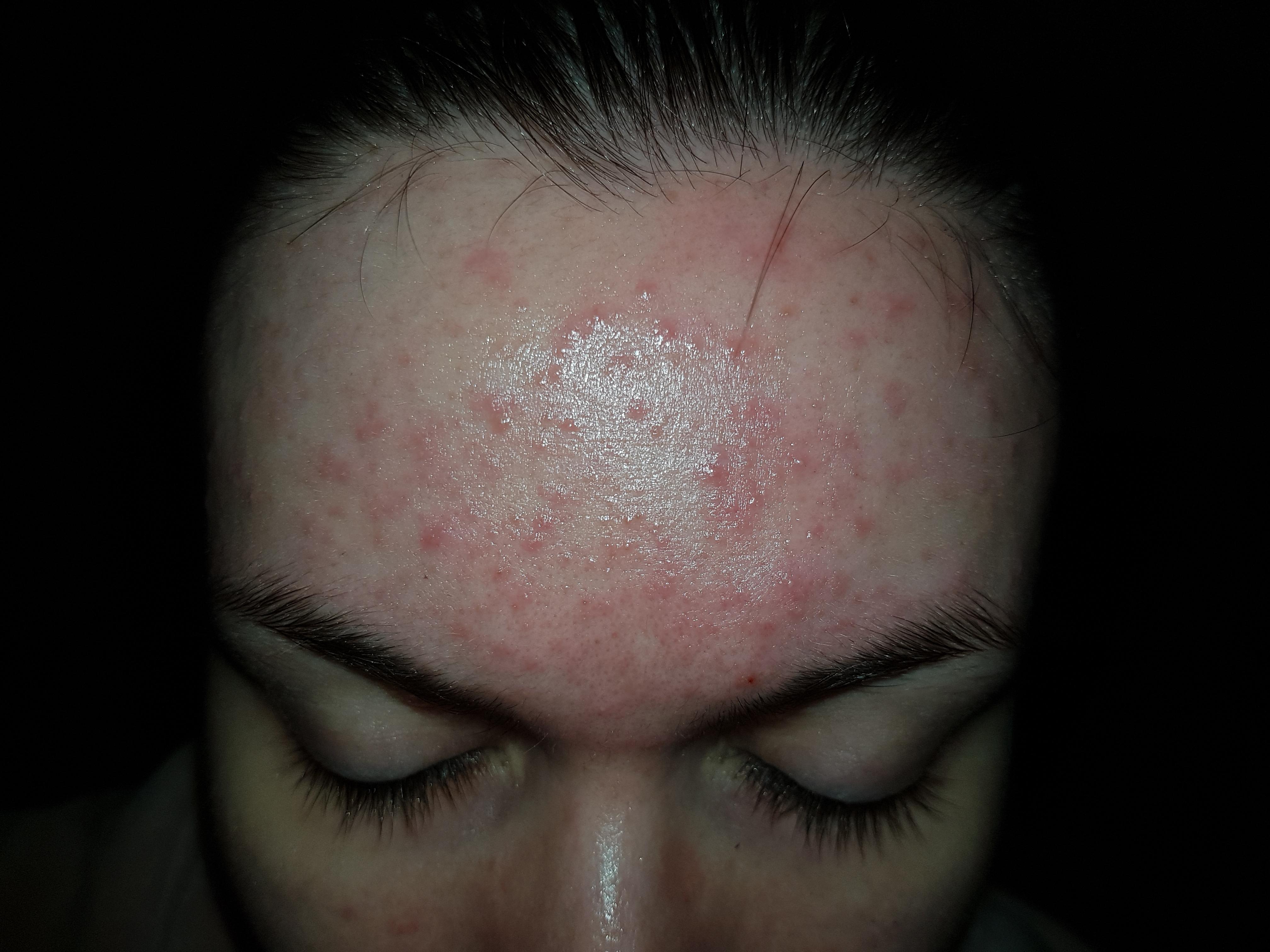 Red Bumps On Forhead Renew Physical Therapy