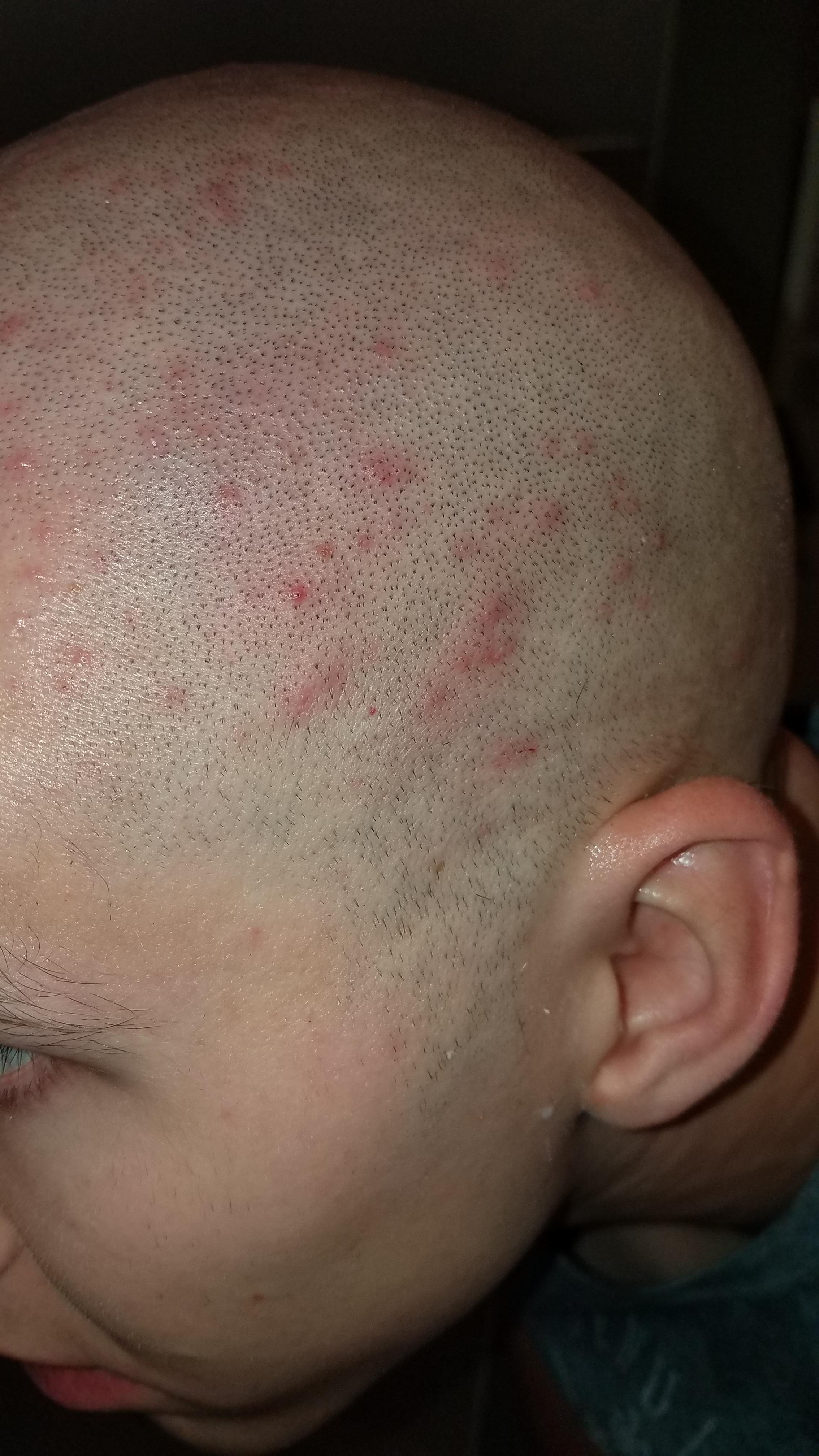 Scalp Acne/Folliculitis (Pictures) General acne