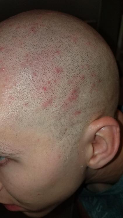 Scalp Acne/Folliculitis (Pictures) - General acne discussion - by