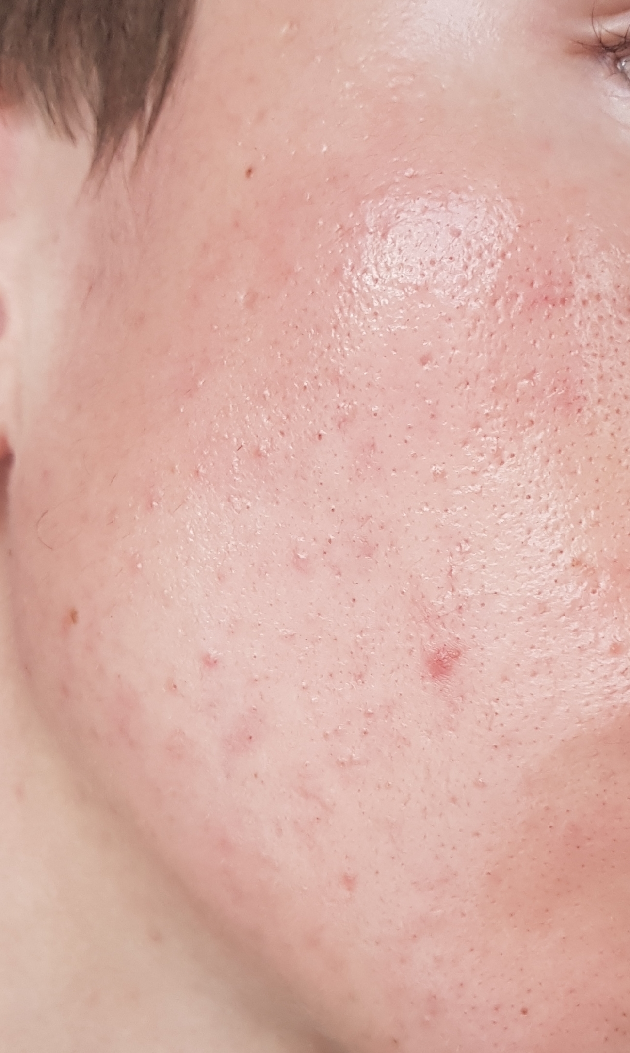 "Post"moderate acne Scars/Hyperpigmentation ...