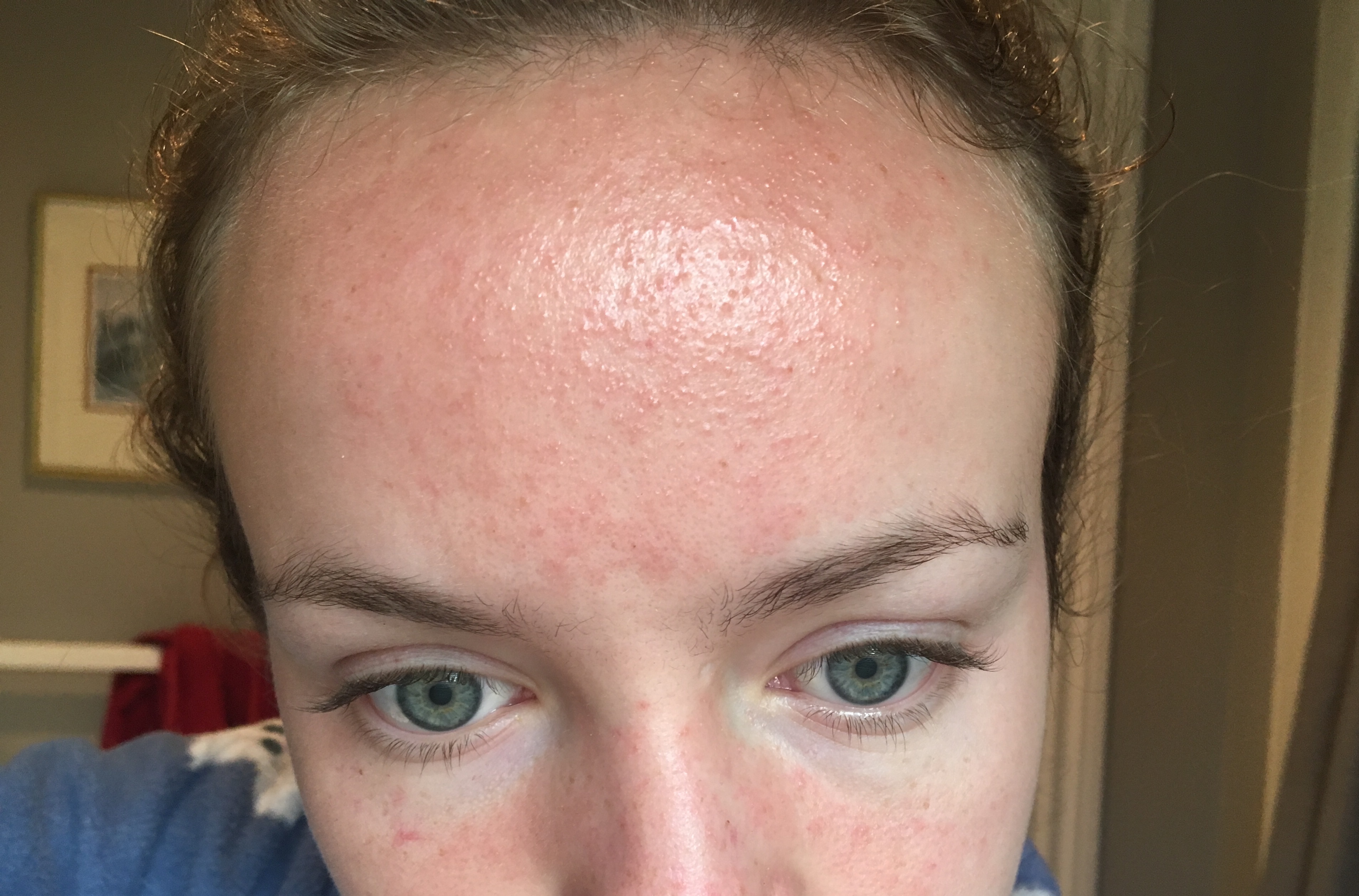 after out accutane breaking forehead