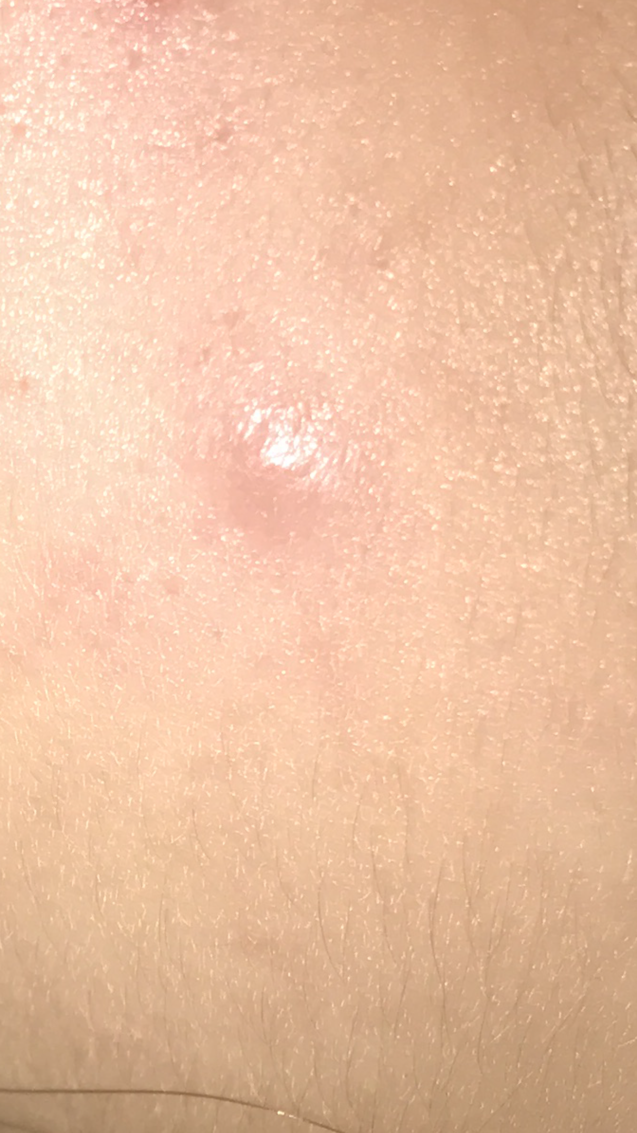 Raised Bump On Skin General Acne Discussion By Labinara