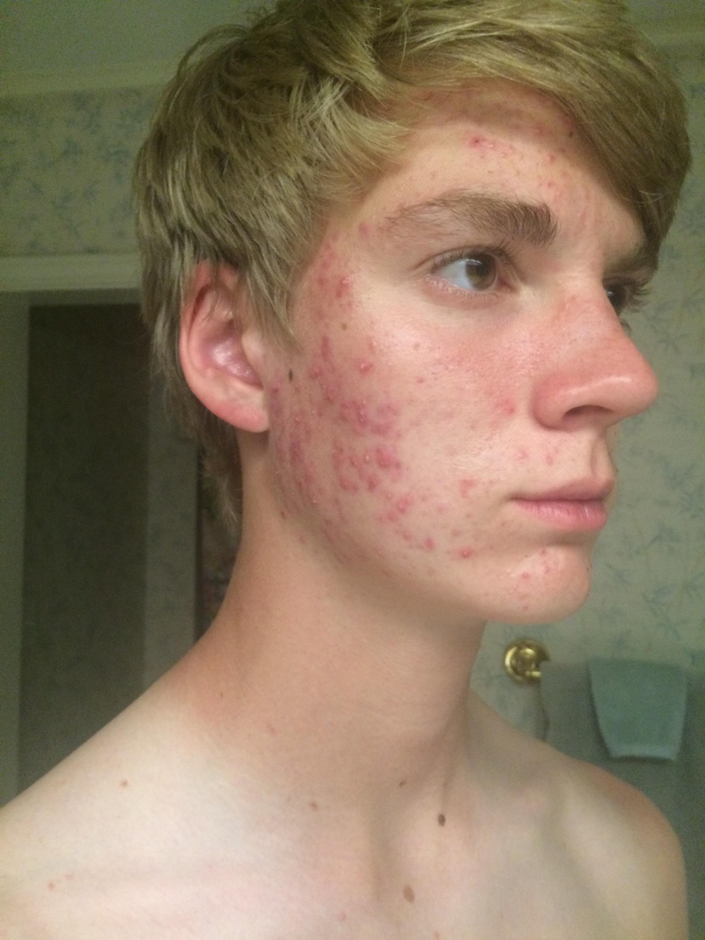 Accutane Before After I Used A Controversial Drug To Permanently Cure My Adult Acne — And I 5556