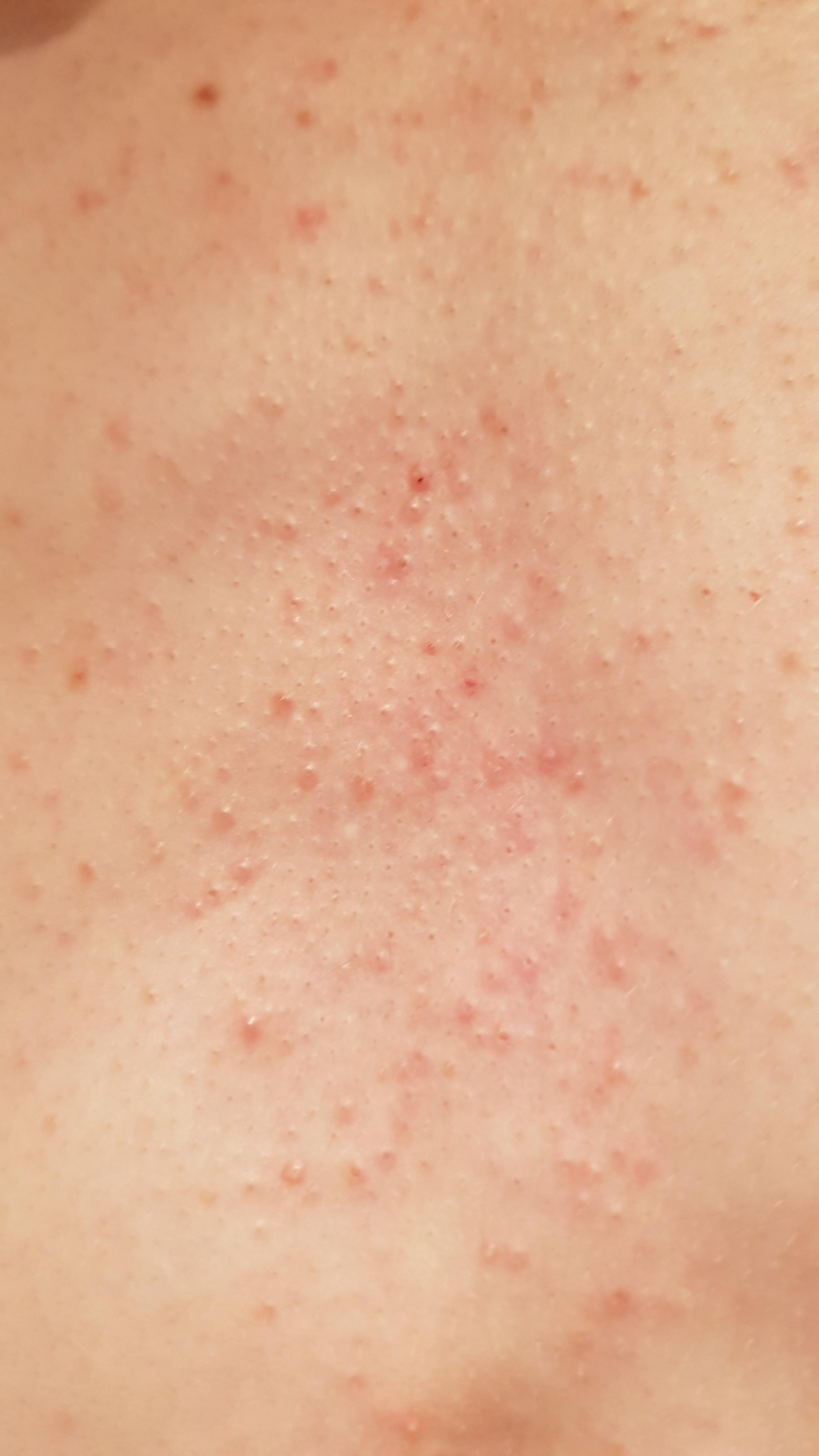 What type of chest acne is this? (M, 17) - Back/Body/Neck acne - by