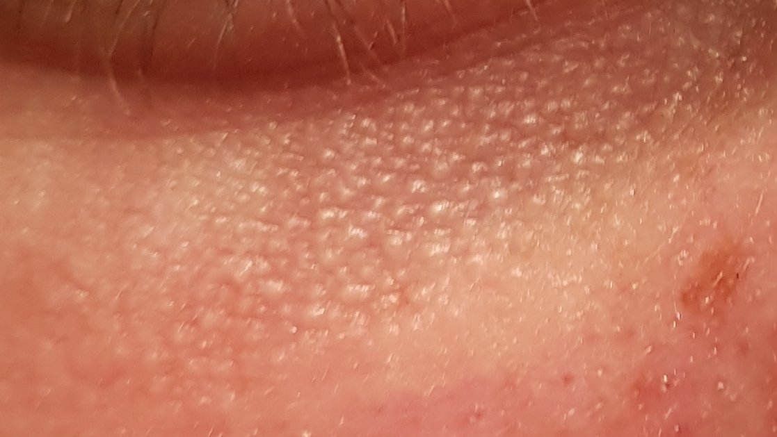 Lots Of Whiteheadsbumps Under Eyes General Acne Discussion Acne