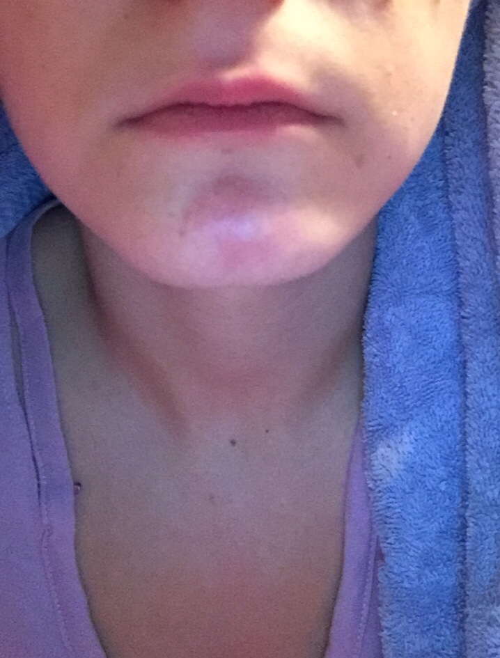 What Is This Hard Red Lump On My Chin Rosacea Facial Redness Acne