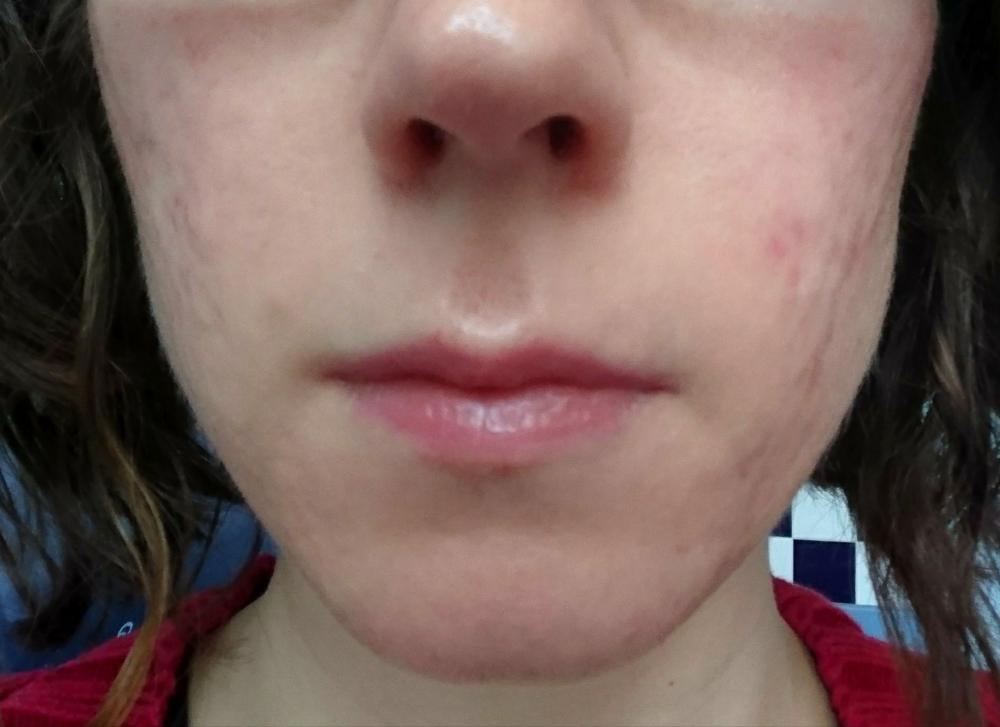 Roaccutane On The Nhs A Uk Blog Page 3 Accutane Isotretinoin