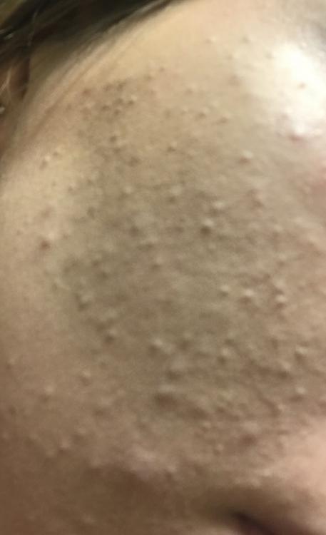 small-bumps-all-over-my-face-general-acne-discussion-acne-forum