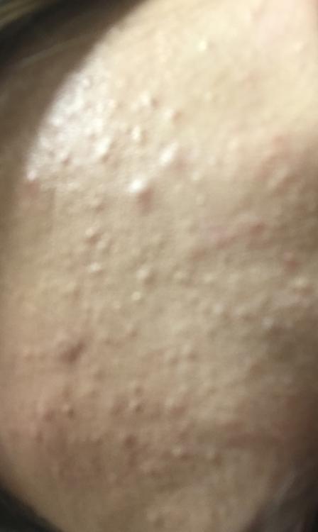 Small Bumps All Over My Face General Acne Discussion 