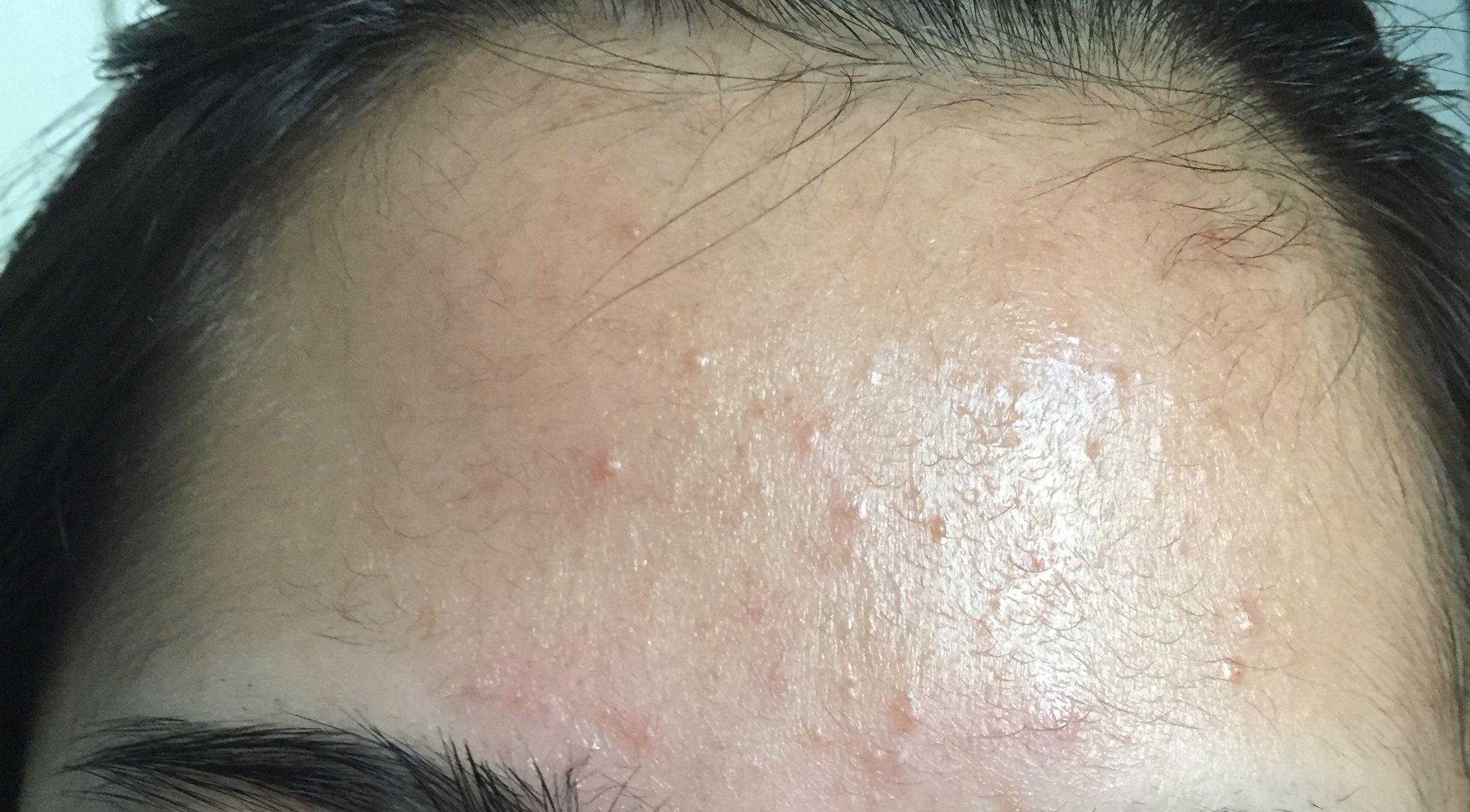 Bumps All Over Forehead General Acne Discussion Community