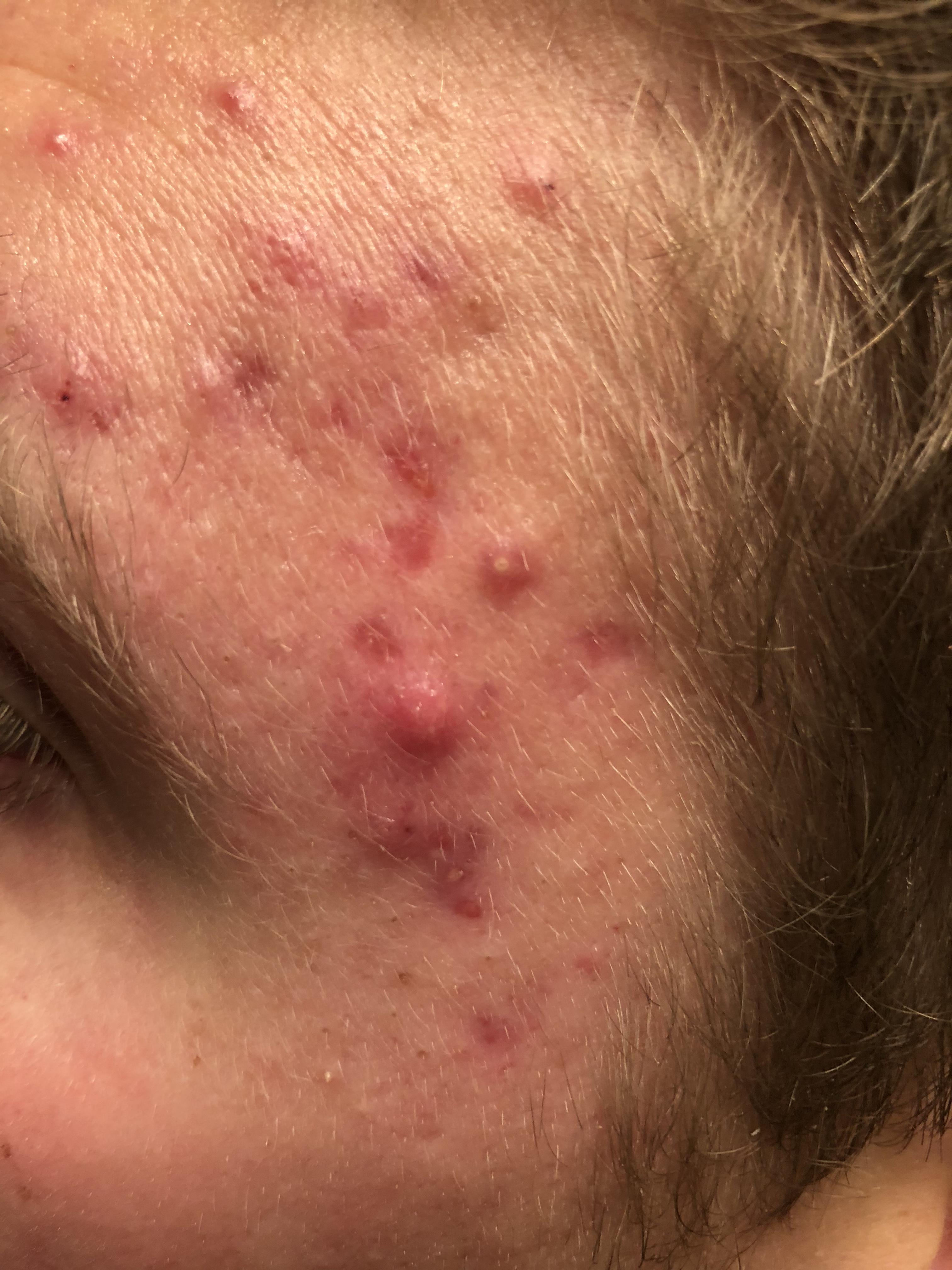 acne-near-temples-adult-acne-acne-forum