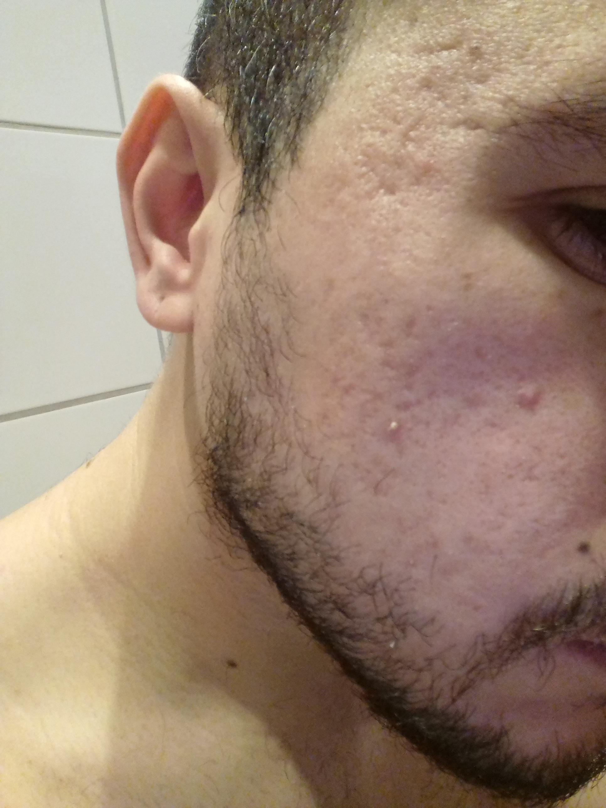 Acne Scars.. help - Scar treatments - Acne.org