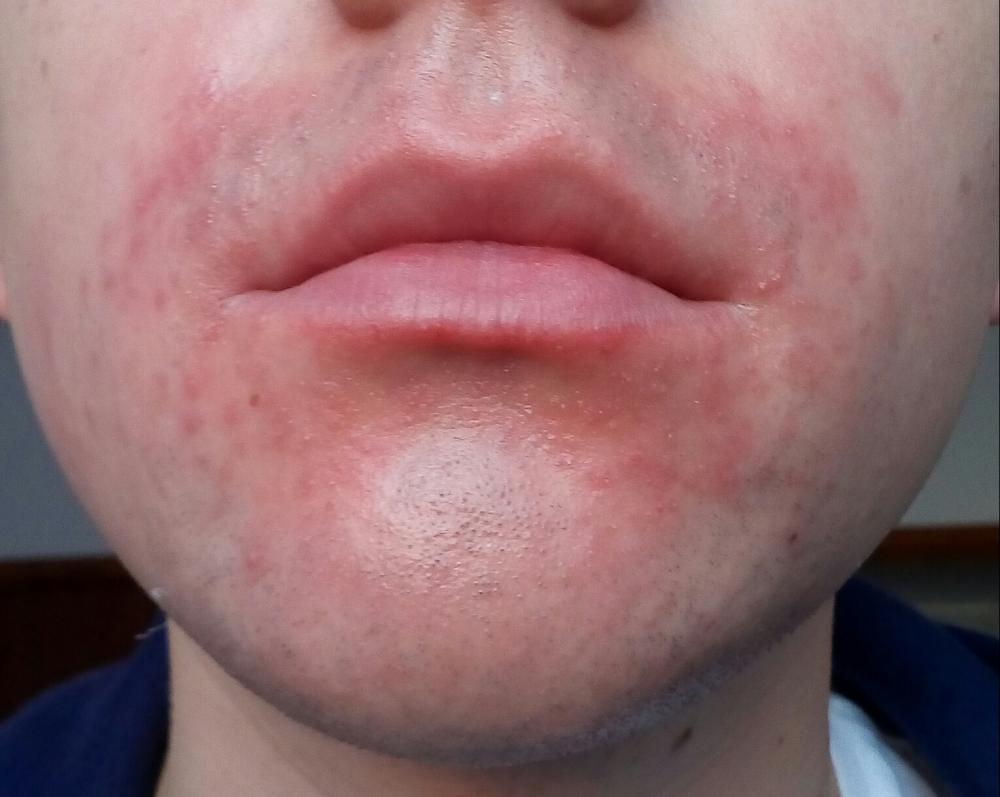 perioral-dermatitis-rosacea-facial-redness-acne-forum