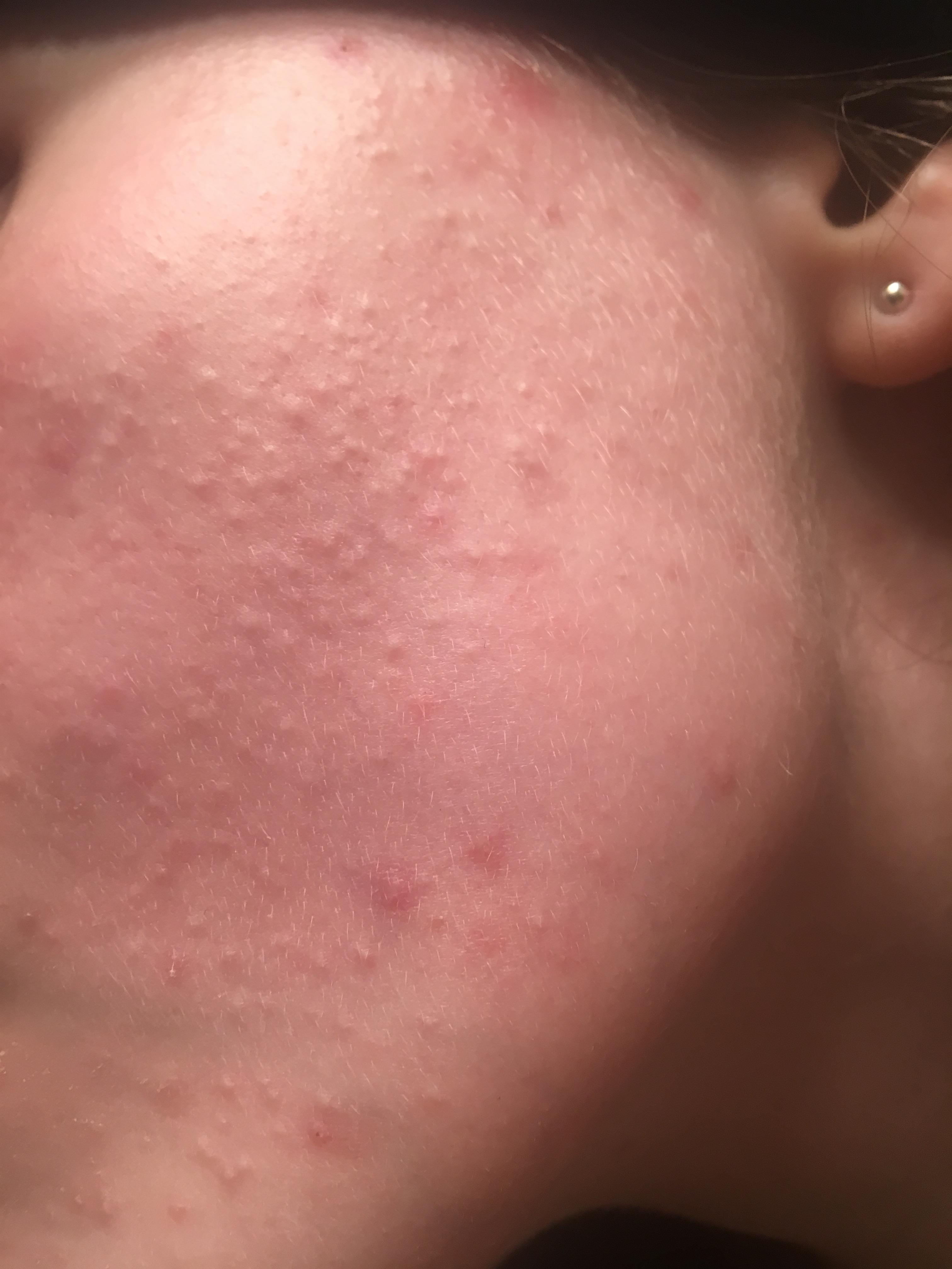 Small flesh colored bumps on cheeks - General acne discussion - by