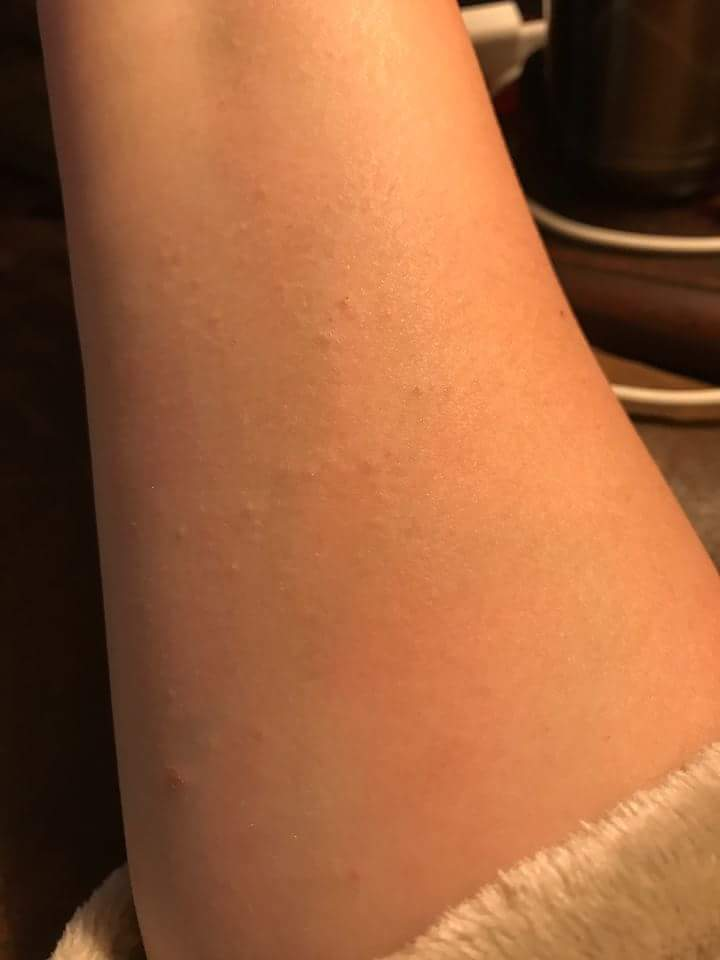 Itchy Bumpsrash On Arm Accutane Isotretinoin Logs