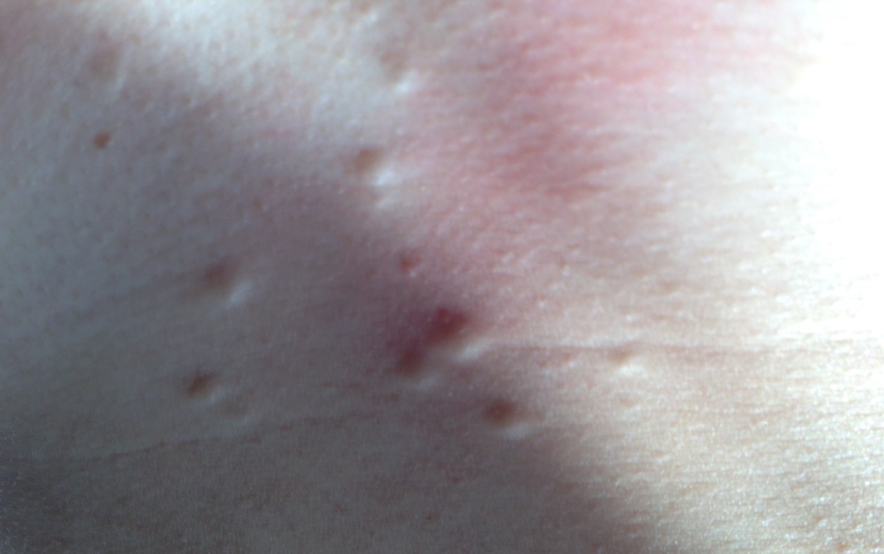 Lots of spots under skin on chest, small lumps – what are they? please ...