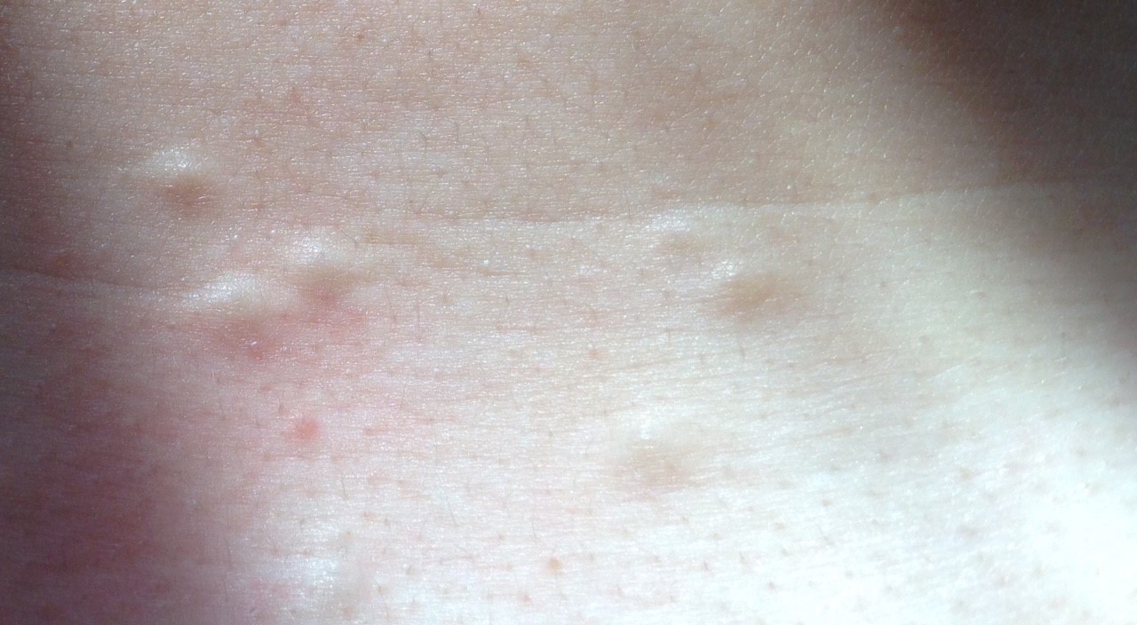 Lots of spots under skin on chest, small lumps – what are they? please ...