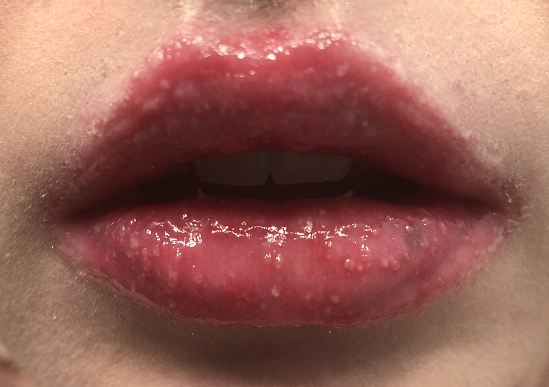 Please Help Tiny Bumpsblisters On Lips Day 15 Of Accutane