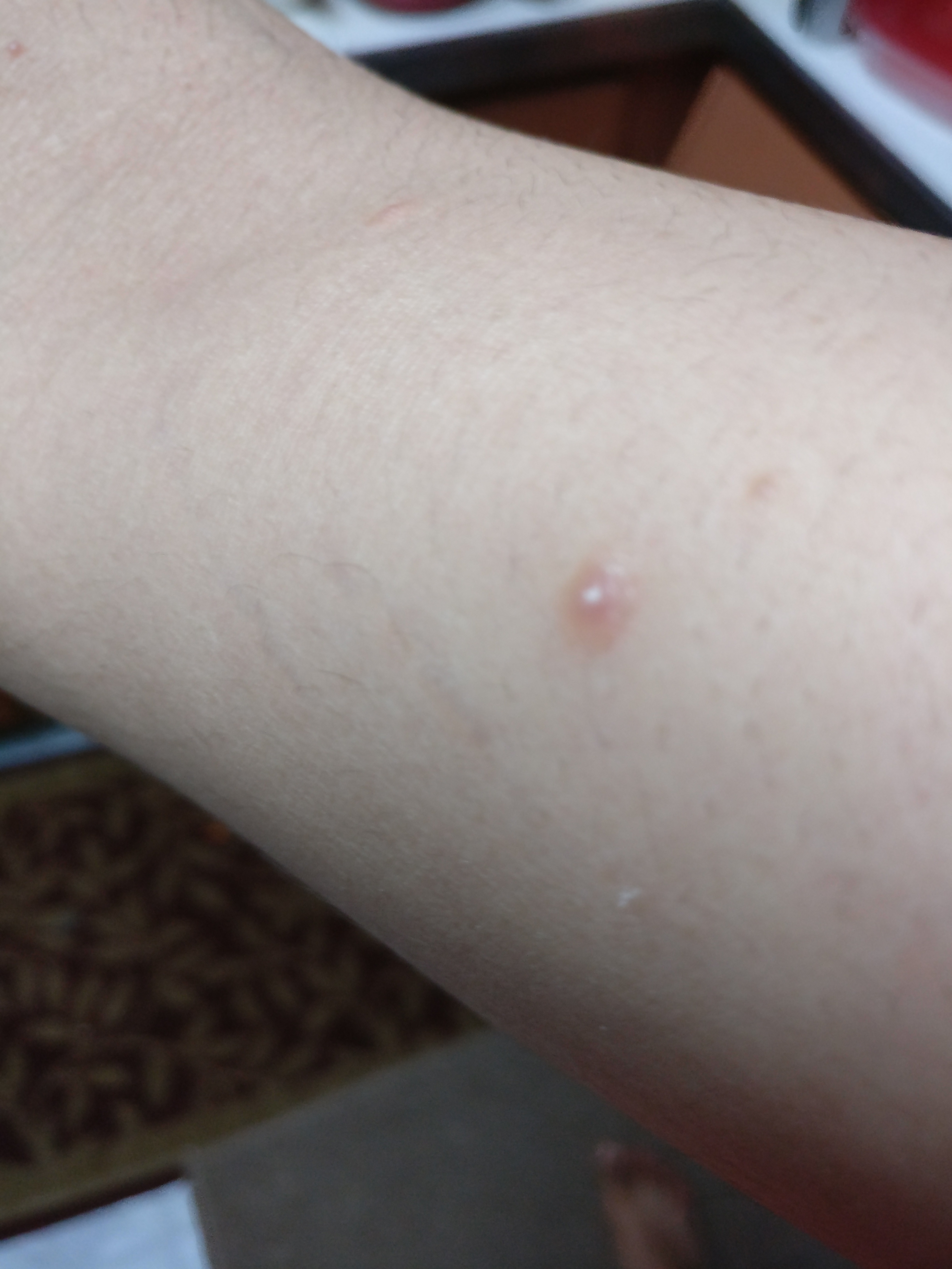 What Is This Ive Had This Pimple On My Arm For A Few A While Now
