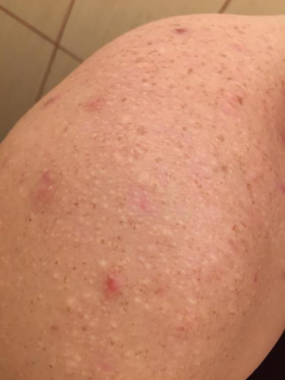White Pimples Tiny Bumps On Shoulders And Chest Backbodyneck Acne