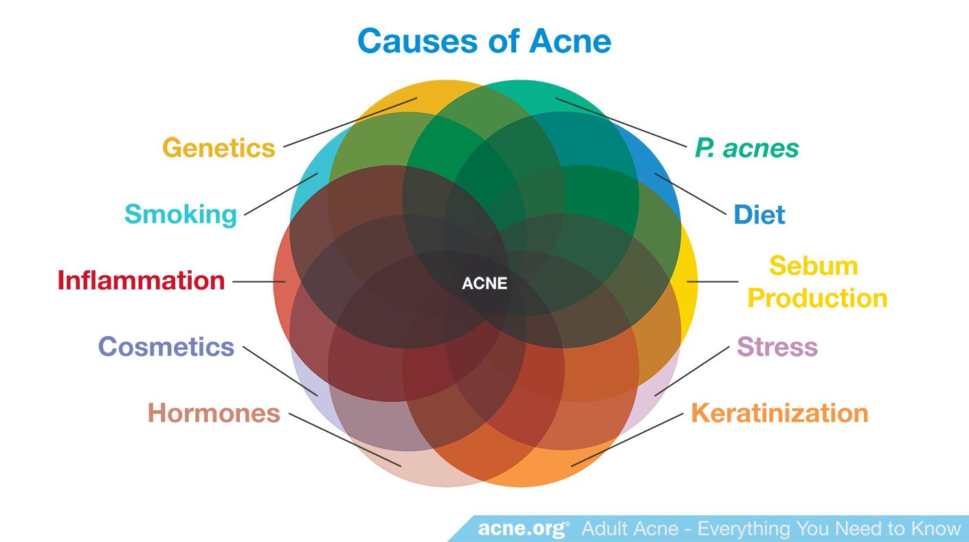 Adult Acne Everything You Need To Know