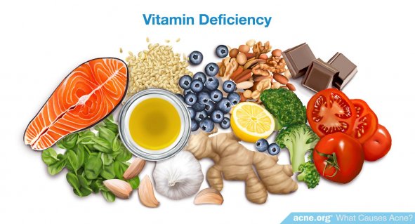 Vitamin Deficiency