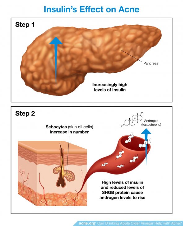 Insulin's Effect on Acne