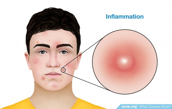 Inflammation