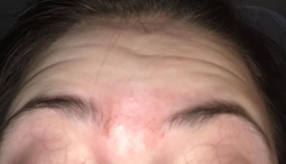 So many hard lumps between eyebrows that have pus in them? - General