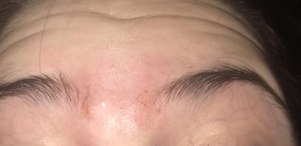 So Many Hard Lumps Between Eyebrows That Have Pus In Them General