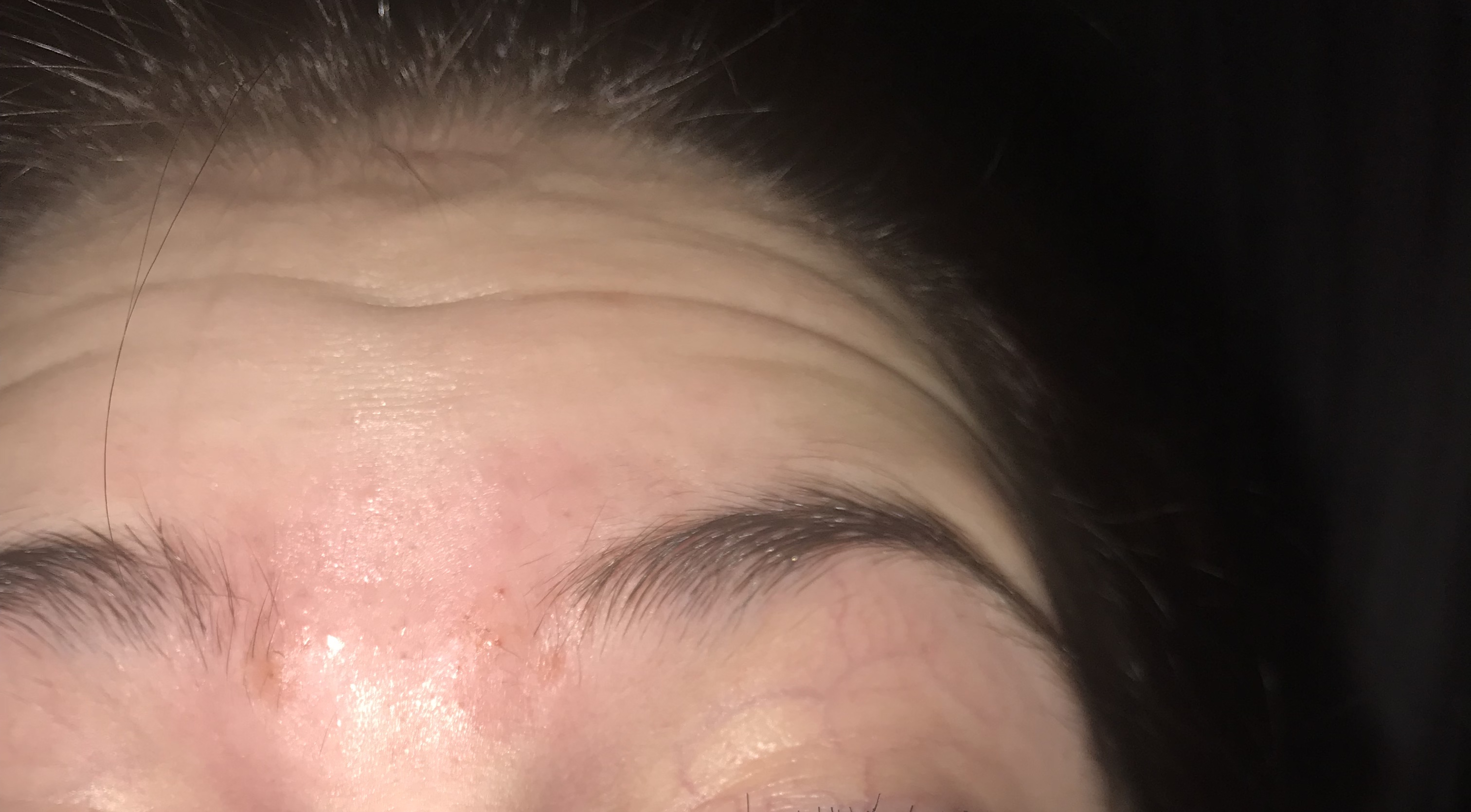 So many hard lumps between eyebrows that have pus in them? - General