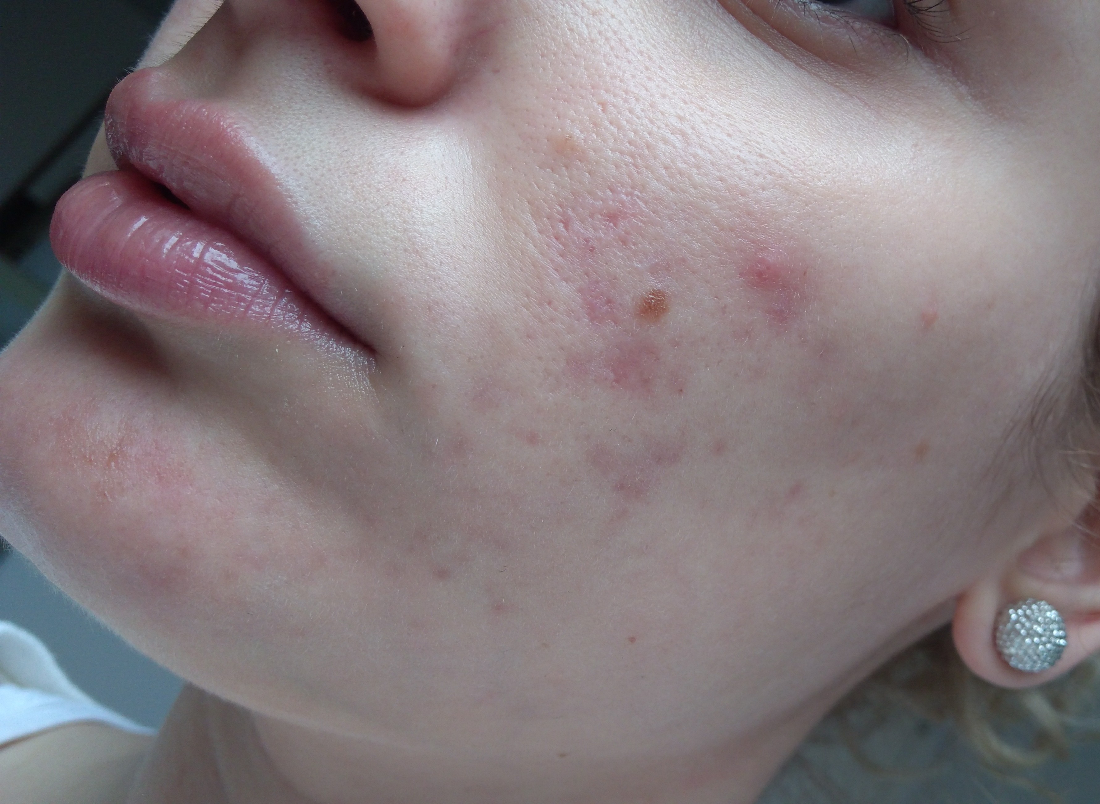 Roaccutane 30mg/for 6 months (PICTURES INCLUDED) - Page 4 - Accutane ...