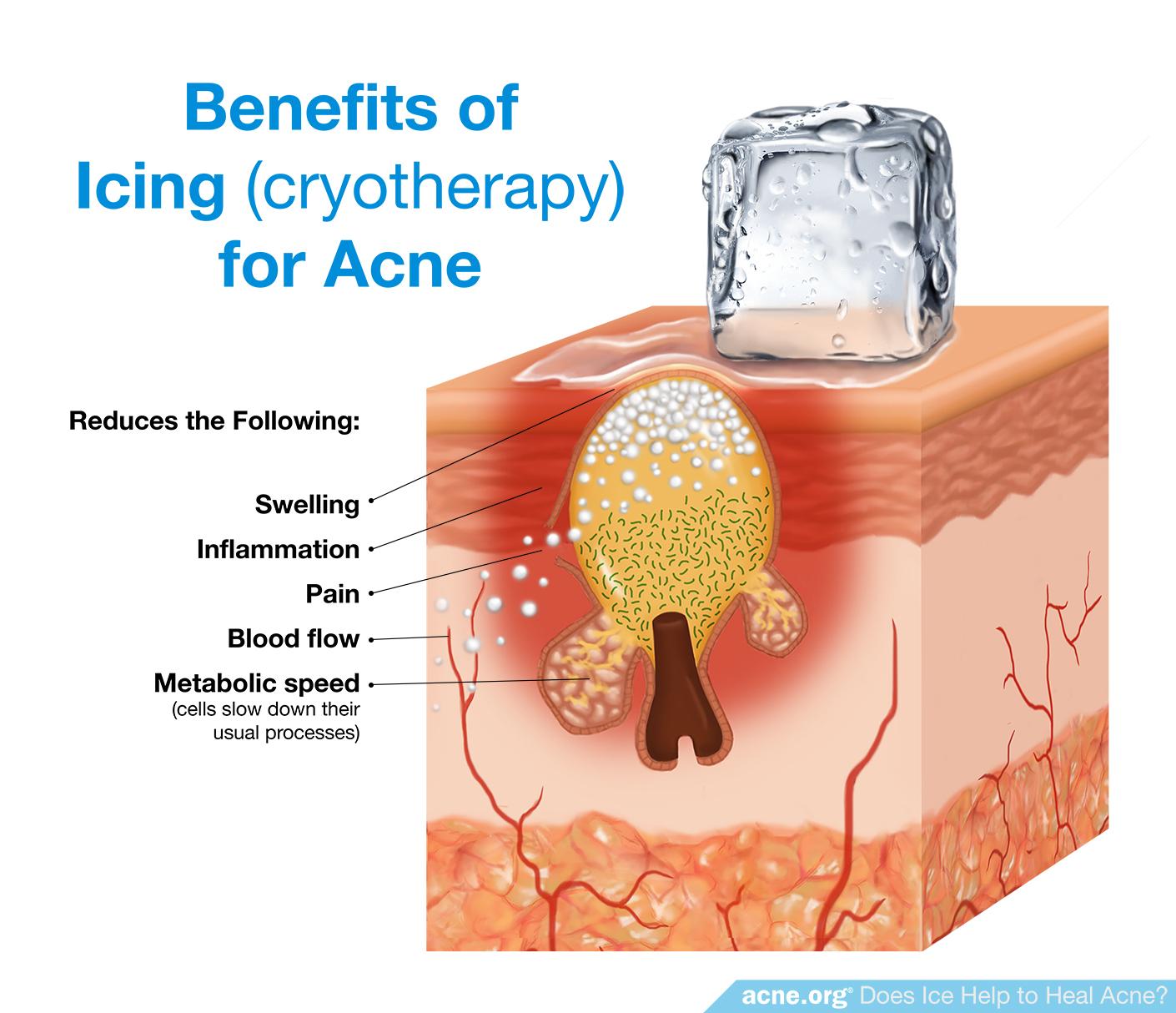 Benefits of Icing (Cryotherapy) for Acne
