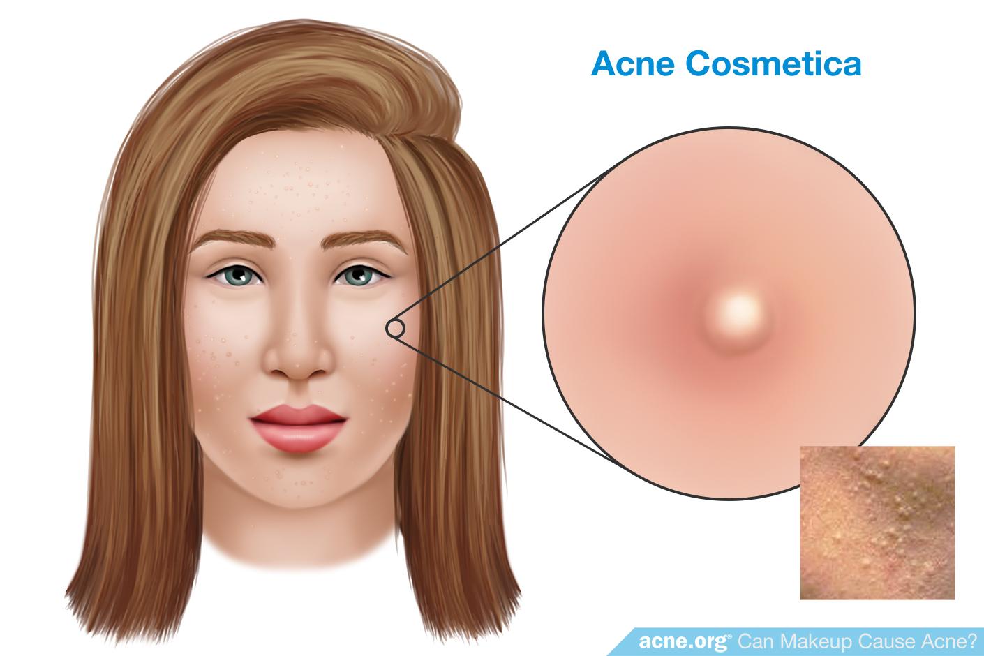 Acne Cosmetica
