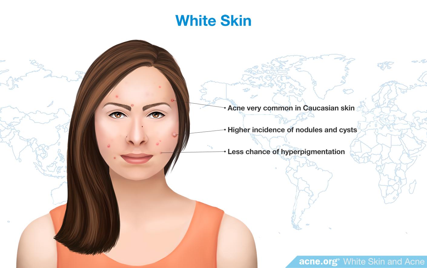 White Skin and Acne