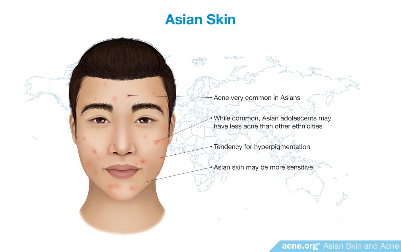 Asian Skin and Acne
