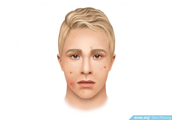 Excoriation Disorder